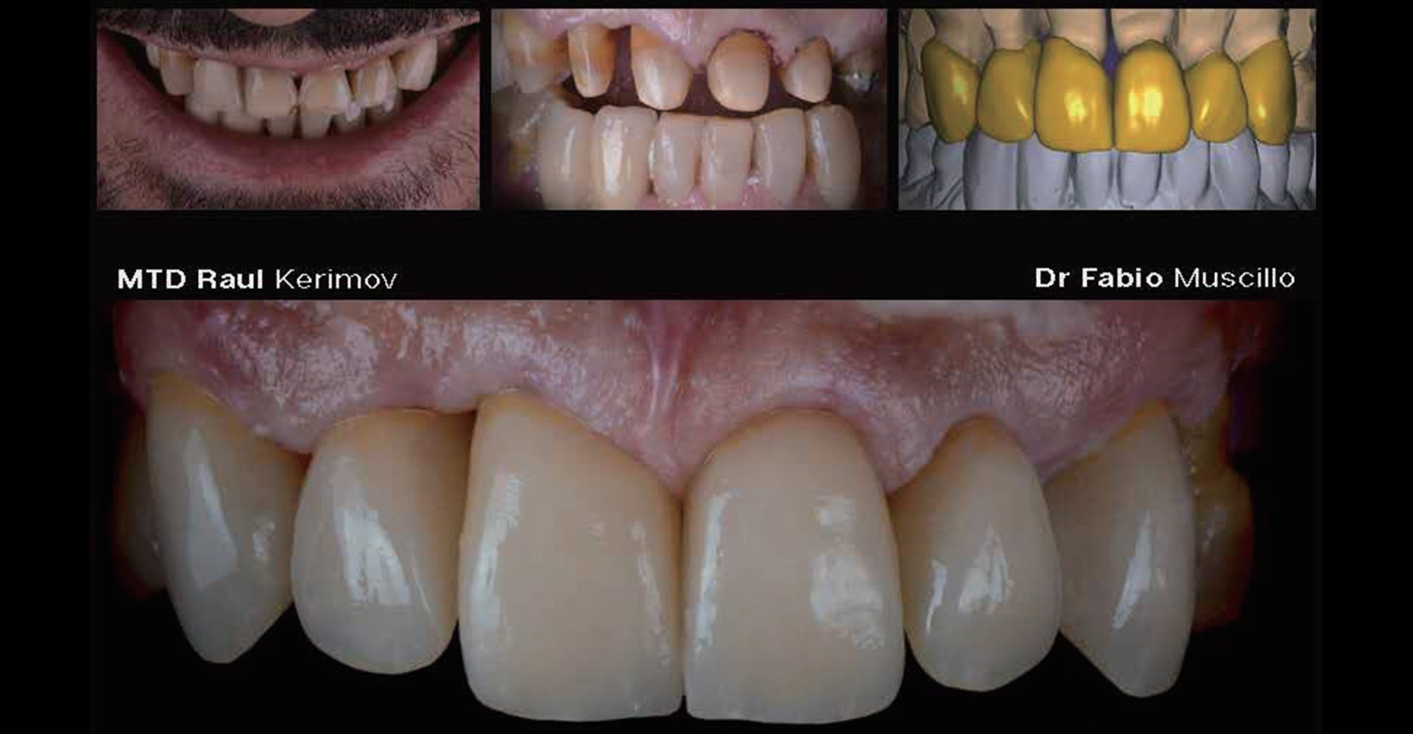Aidite 3d Pro Zir, multilayer zirconia - Aidite